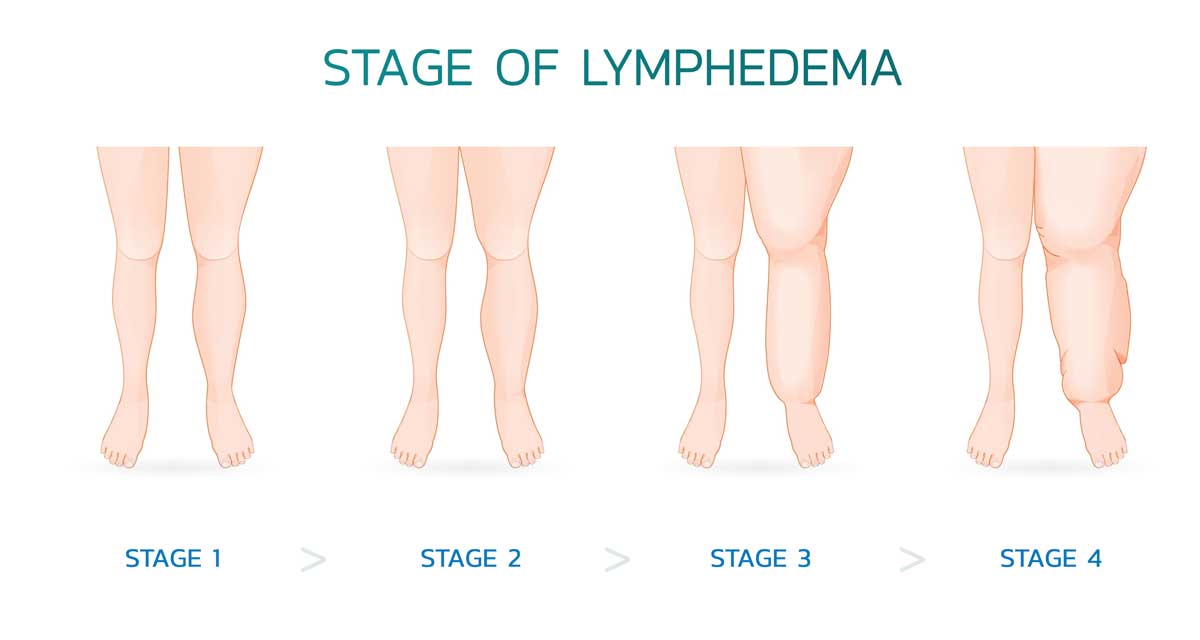 About Lymphedema - Lymphatica Medtech